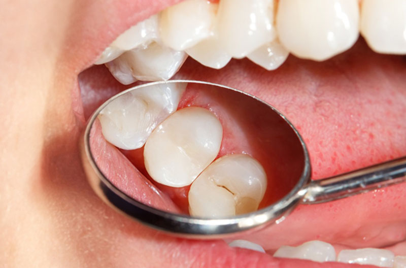 Болит зуб под пломбой, что делать? - Стоматологическая клиника Santa Apolonia